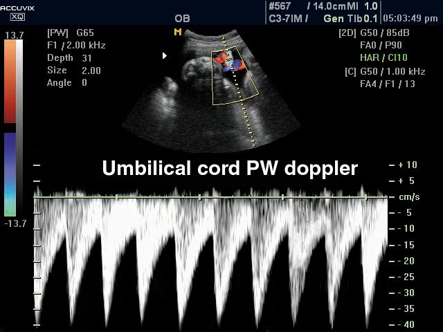 Umbilical cord, CFM & PW (echogramm №308)