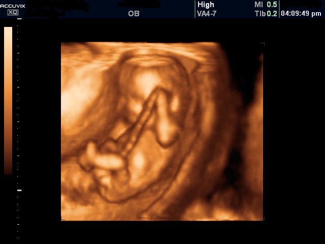 Fetus, 3D (echogramm №309)