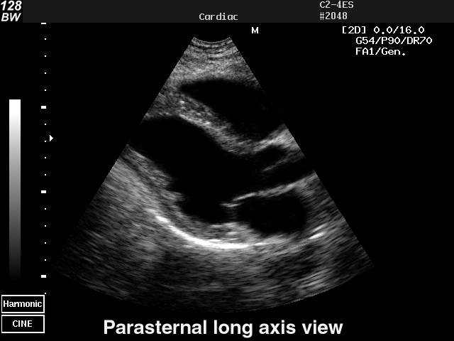 Heart (long  axis of LV), B-mode (echogramm №31)