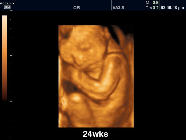 Fetus - 24 weeks, 3D (echogramm №310)