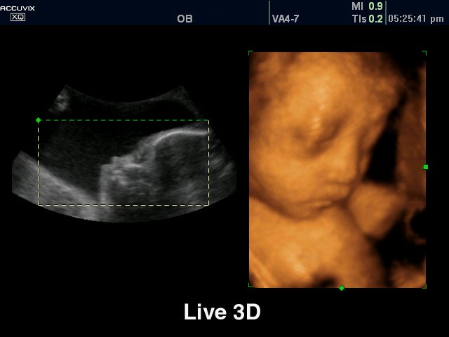 Fetus, Live 3D (echogramm №312)