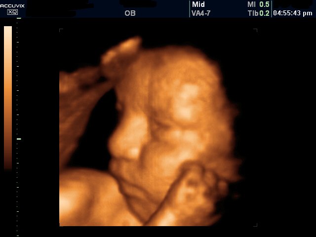 Fetal face, 3D (echogramm №313)