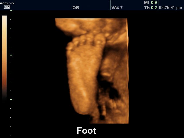 Fetal foot, 3D (echogramm №314)
