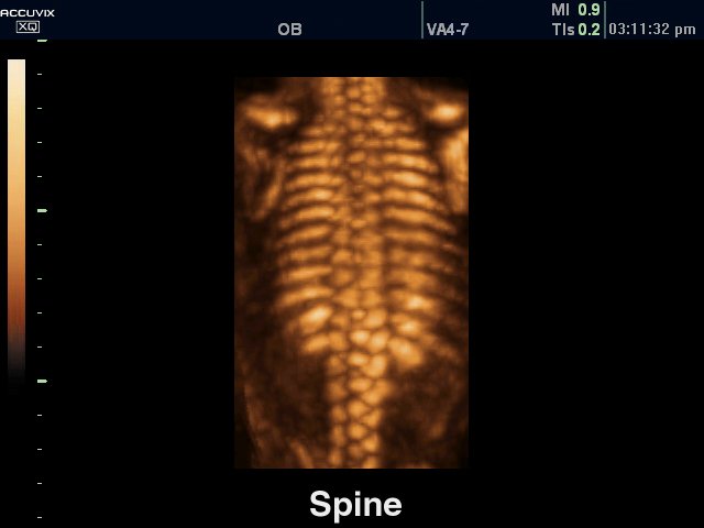 Fetal spine, 3D (echogramm №316)