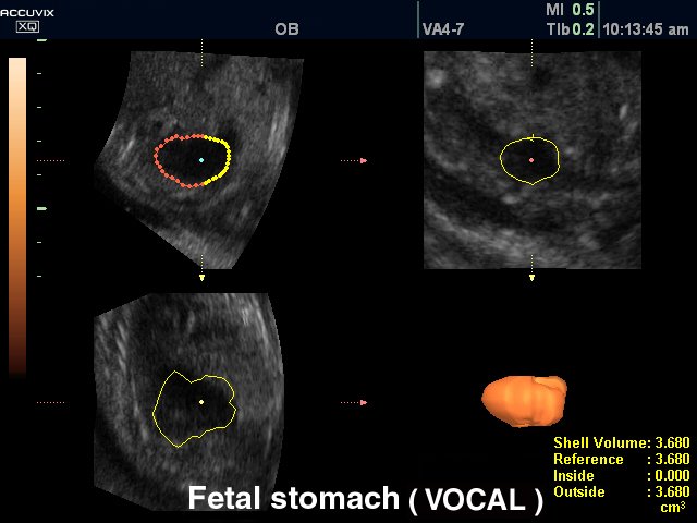Fetal stomach, VOCAL (echogramm №317)
