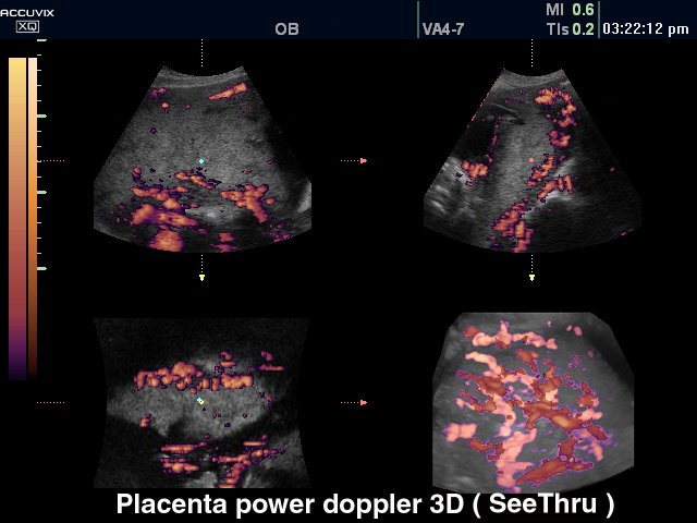 Placenta, power doppler, 3D (echogramm №318)