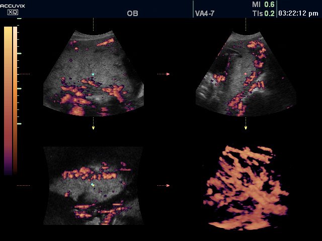 Placenta, power doppler, 3D (echogramm №319)