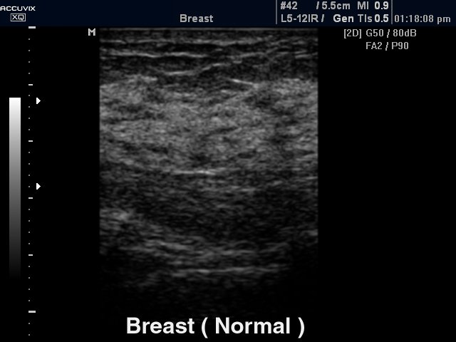 Breast - norm, B-mode (echogramm №320)
