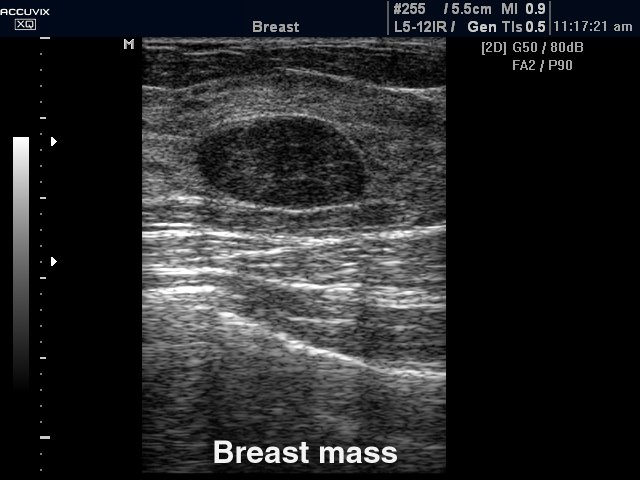 Breast nodule, B-mode  (echogramm №321)