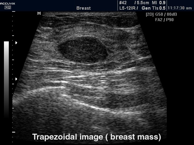 Breast nodule, trapezoidal mode (echogramm №322)