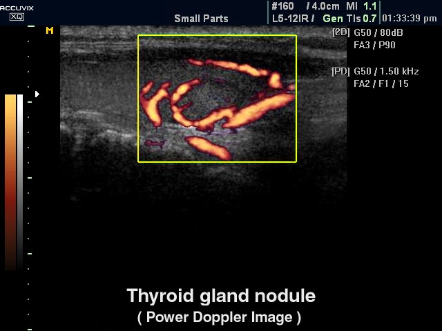 Thyroid nodule, power doppler (echogramm №324)