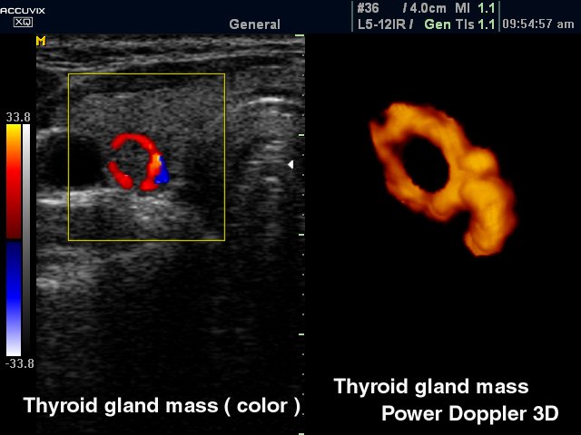 Thyroid nodule, CFM & power doppler in 3D (echogramm №325)