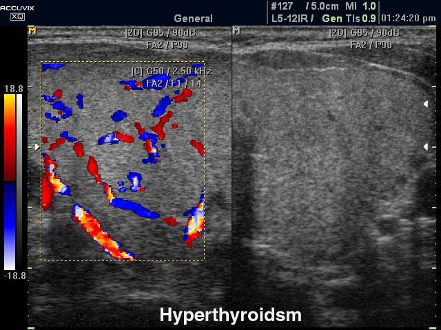 Hyperthyroidsm, CFM & B-mode (echogramm №326)