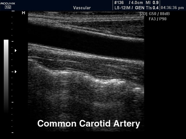 Common carotid artery, B-mode (echogramm №327)