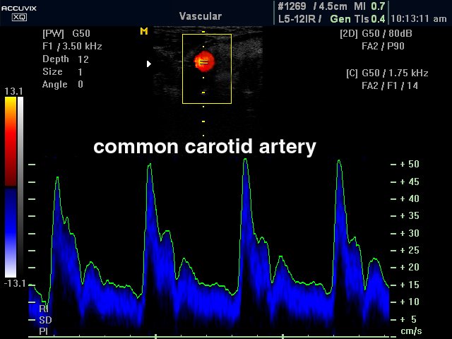 Common carotid artery, CFM & PW (echogramm №329)