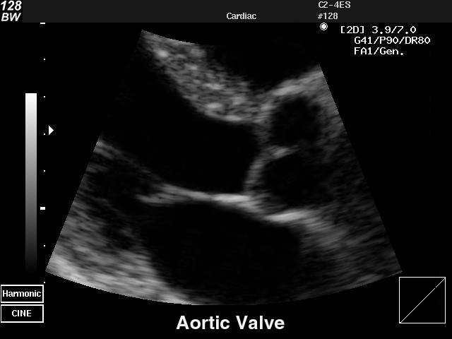 Aortic valve, B-mode (echogramm №33)