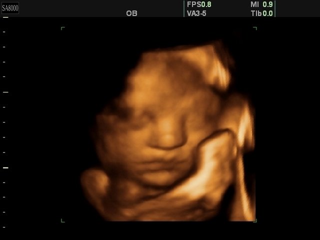 Fetal face - 34 weeks, 3D (echogramm №334)