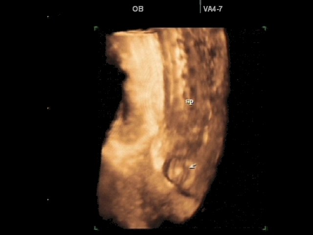 Meningocele - defect of fetal`s development, 3D (echogramm №336)