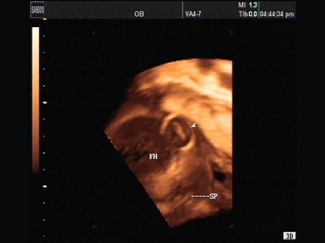 Hydrocephaly - defect of fetal`s development, 3D (echogramm №337)