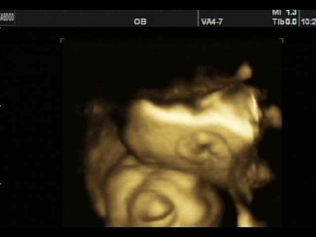 Anencephaly - defect of fetal`s development, 3D (echogramm №338)