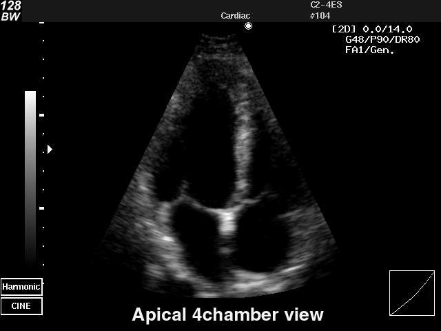 Fetal heart (4 chamber view), B-mode (echogramm №34)