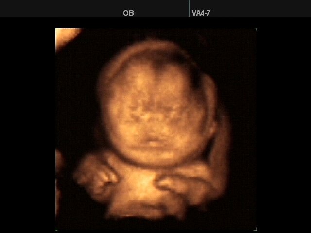 Swell of face and body - defect of fetal`s development, 3D (echogramm №340)