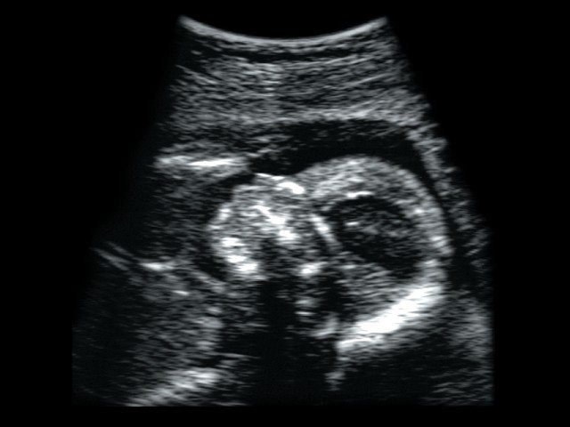 Fetal head, B-mode (echogramm №343)