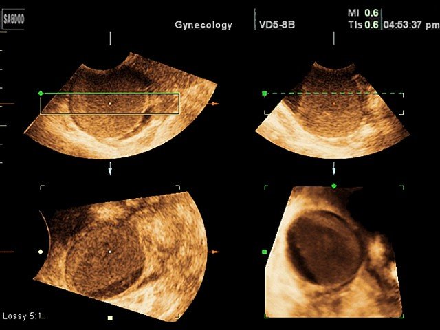 Ovarian cyst, 3D (echogramm №344)