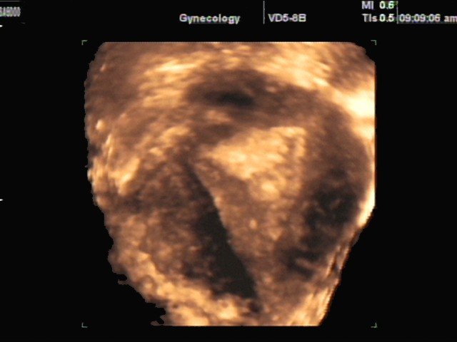 Endometrial polyp, 3D (echogramm №345)