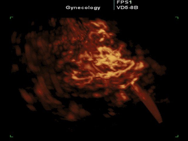 Uterine myoma, power doppler, 3D (echogramm №346)