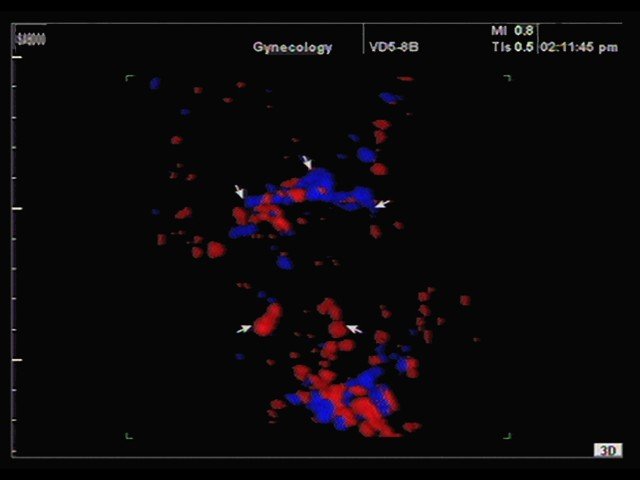 Uterine myoma, color doppler, 3D (echogramm №347)