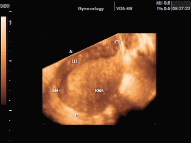 Myometrium, 3D (echogramm №348)