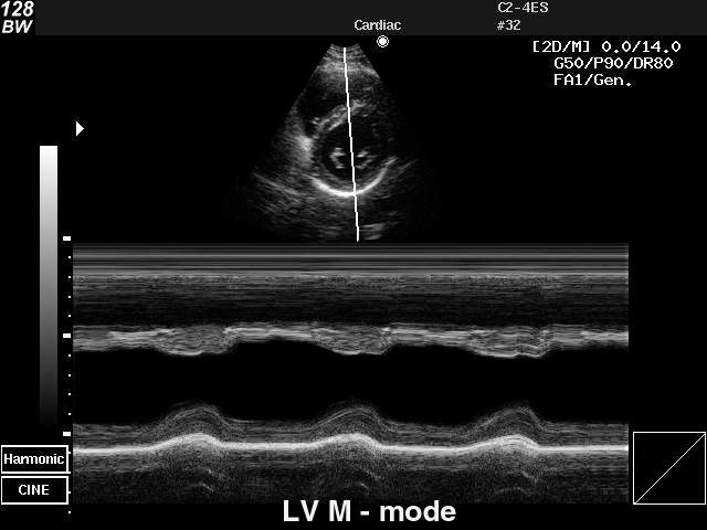 Heart - left ventricle, M-mode (echogramm №35)