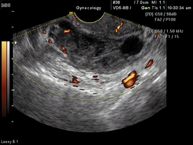 Ectopic pregnancy, power doppler (echogramm №350)