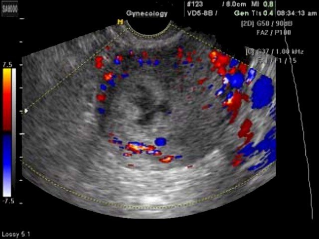 Uterus - subchorionic bleeding, color doppler (echogramm №352)