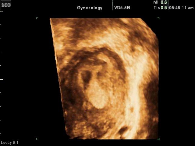 Uterus - subchorionic bleeding, 3D (echogramm №353)