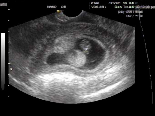 Uterus - subchorionic bleeding, B-mode (echogramm №356)