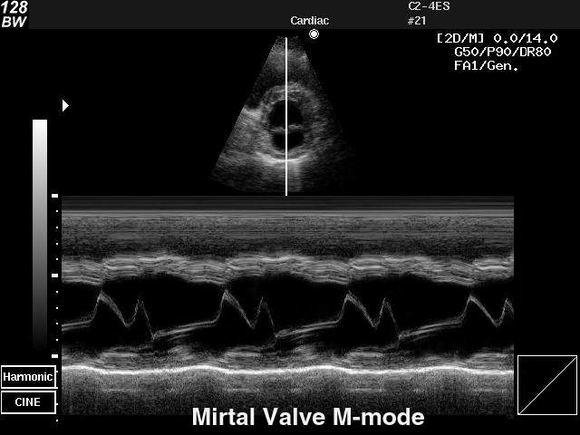 Mirtal valve, M-mode (echogramm №36)