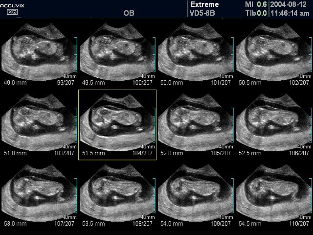 Fetus - nuchal translucency, MSV (echogramm №369)