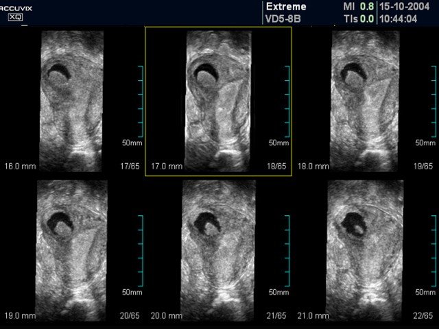 Bicornate uterus, MSV (echogramm №370)