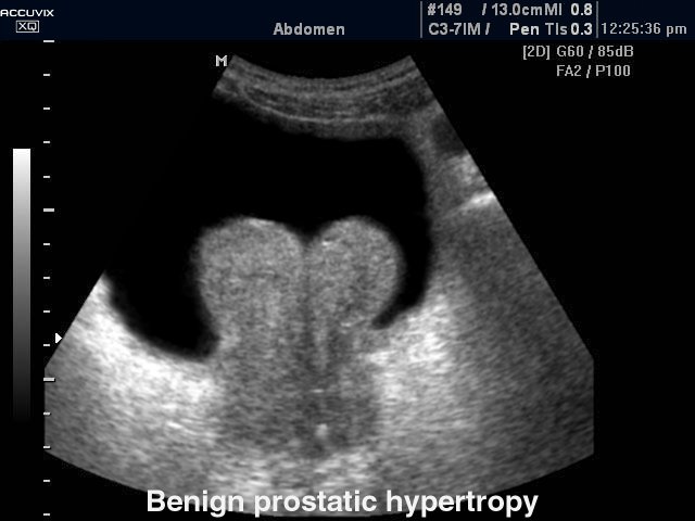 Prostate - BPH, B-mode (echogramm №371)