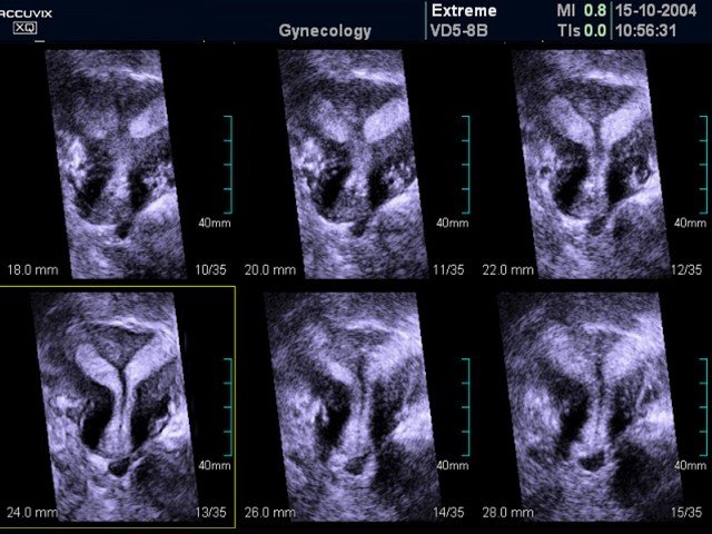 Bicornate uterus, MSV (echogramm №372)