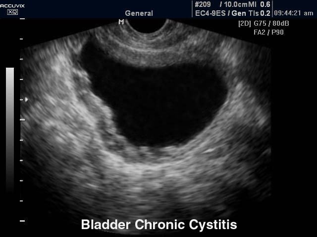 Bladder - chronic cystitis, B-mode (echogramm №373)