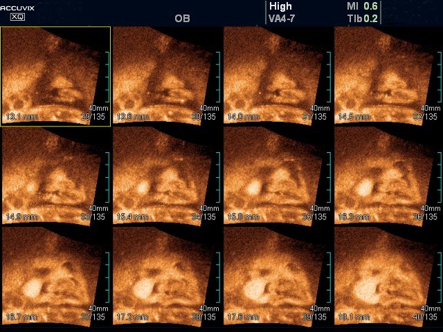 Fetus - cleft lip, MSV (echogramm №374)