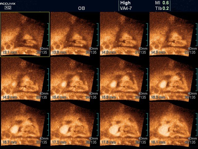 cleft lip 3d ultrasound