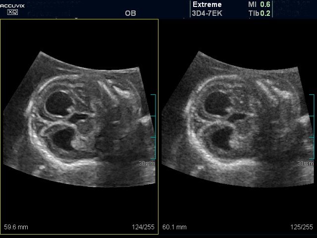 Fetal brain - expansion of the lateral ventricles, MR (echogramm №375)