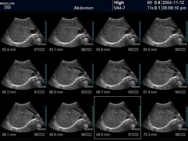 Liver, MSV (echogramm №376)