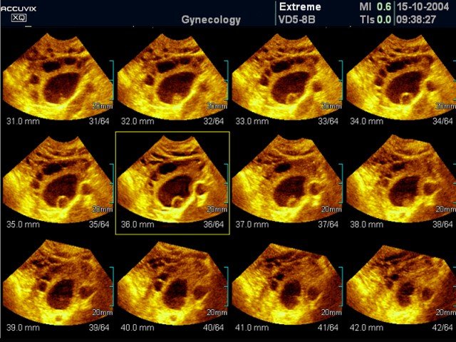 Ovary - cyst, MSV (echogramm №378)