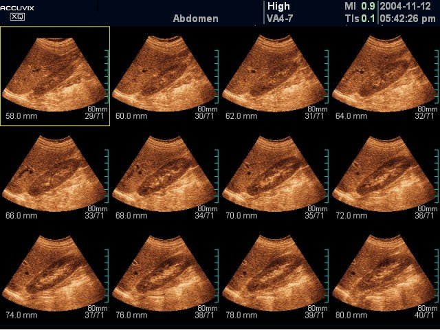 Kidney, MSV (echogramm №379)