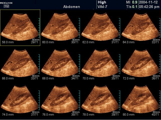 Kidney, MSV (echogramm №379)